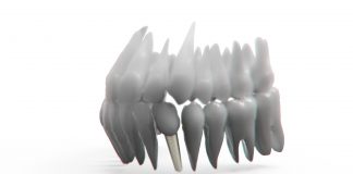 implant dentar